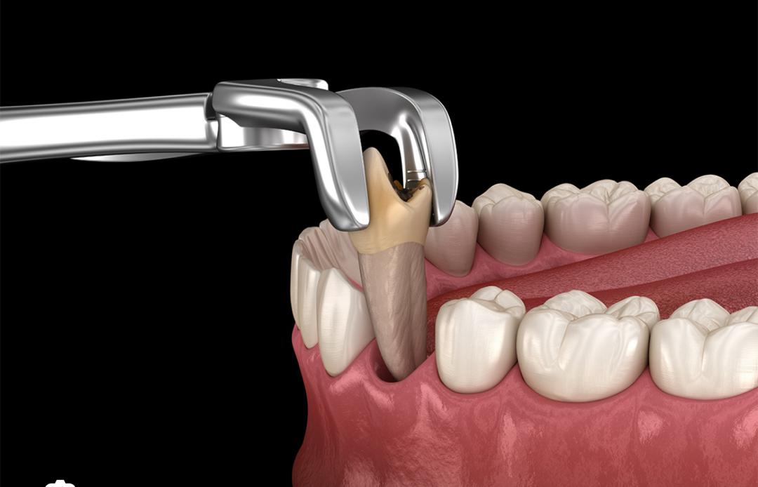 Oral Surgery